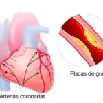 ENFERMEDAD CORONARIA
