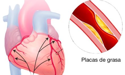 ENFERMEDAD CORONARIA