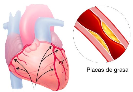 ENFERMEDAD CORONARIA